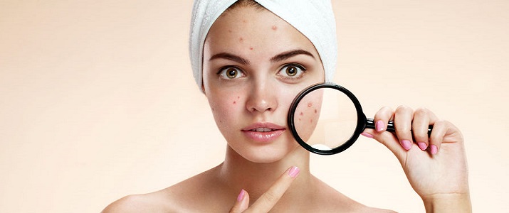 Dealing With Acne